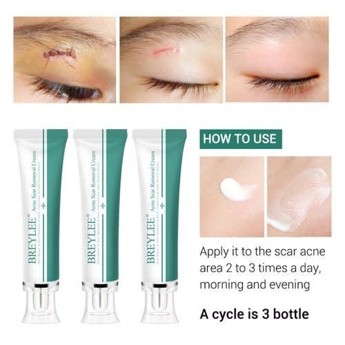 Breylee Acne Scar Removal Cream For Scars - Stretch Marks - 30g X 3pcs - View 5