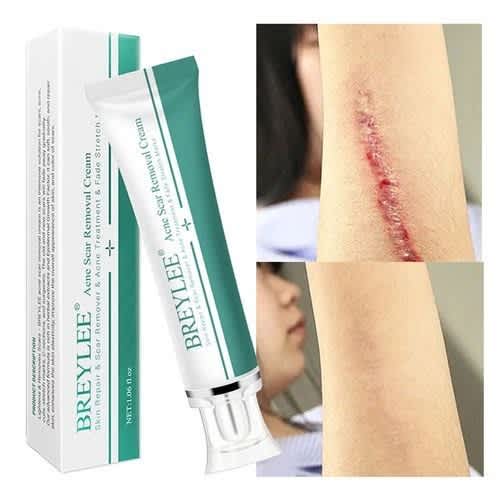 Breylee Acne Scar Removal Cream For Scars - Stretch Marks - 30g X 3pcs