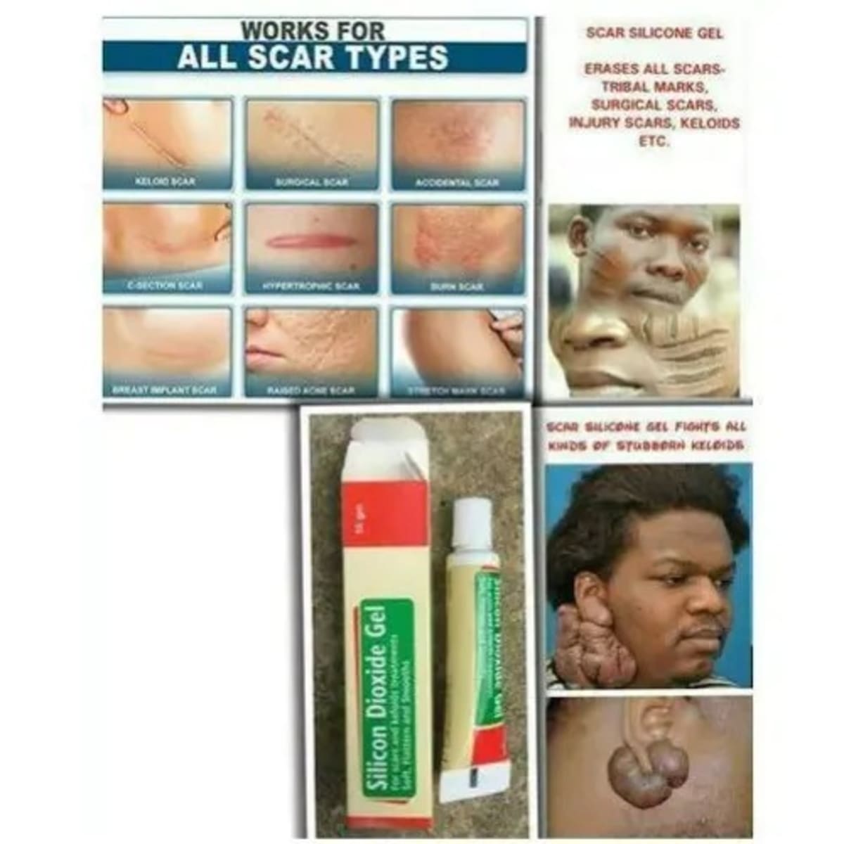 Silicone Gel For Scars Tribal Marks - 10g