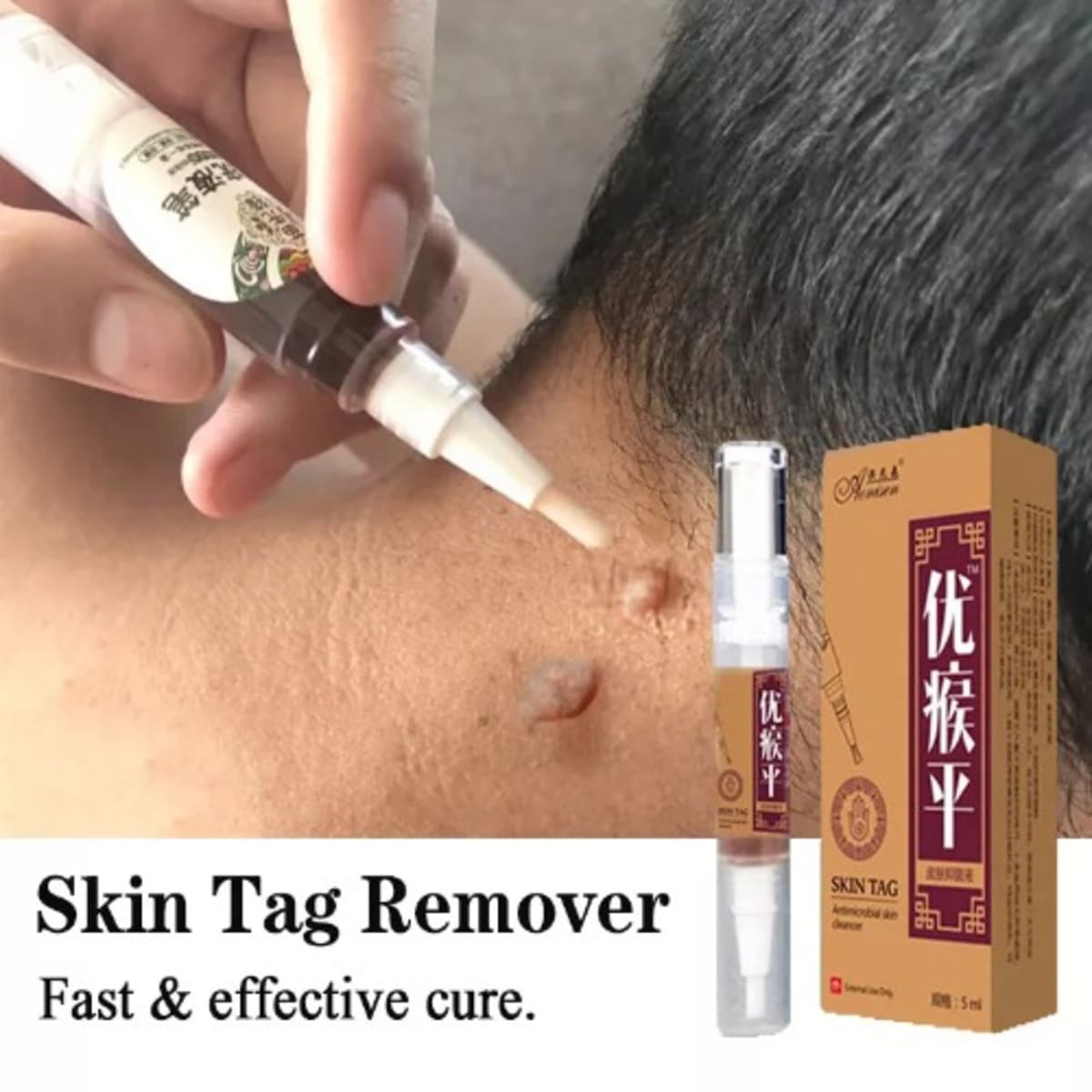 Skin Tag Wart Laser Tattoo Mole Remover Pen