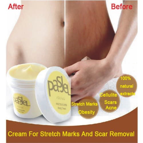 stretch marks